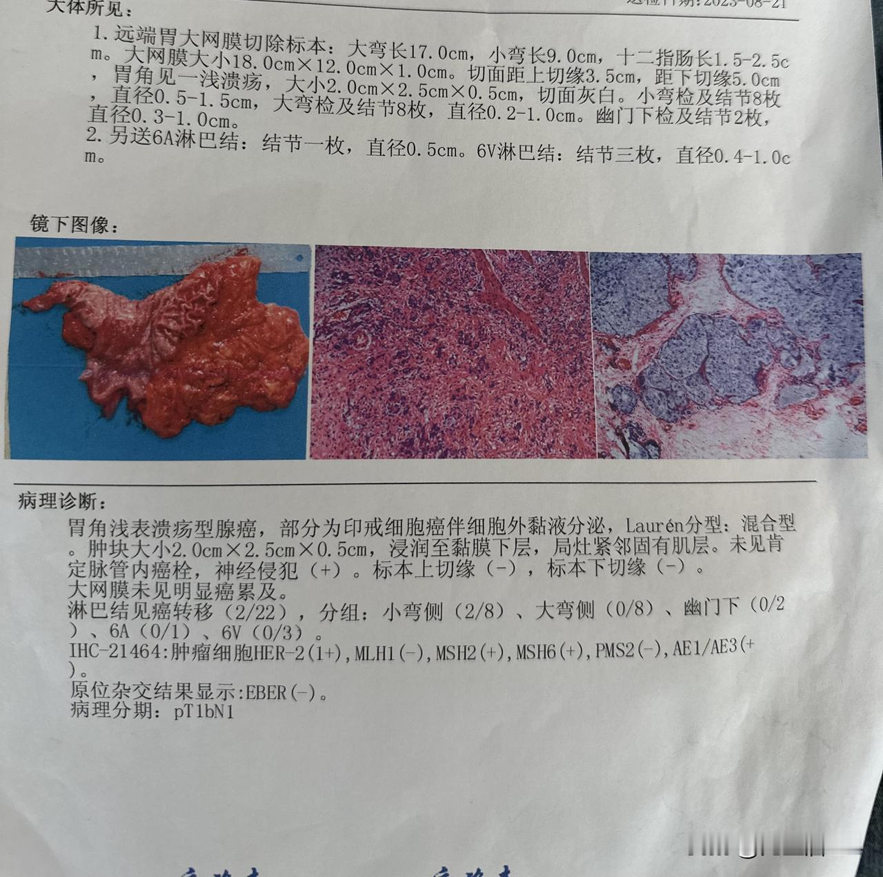 胃癌怎么分早、中、晚期？TNM分期标准是什么？经常有人问我得的胃癌是早期中期，