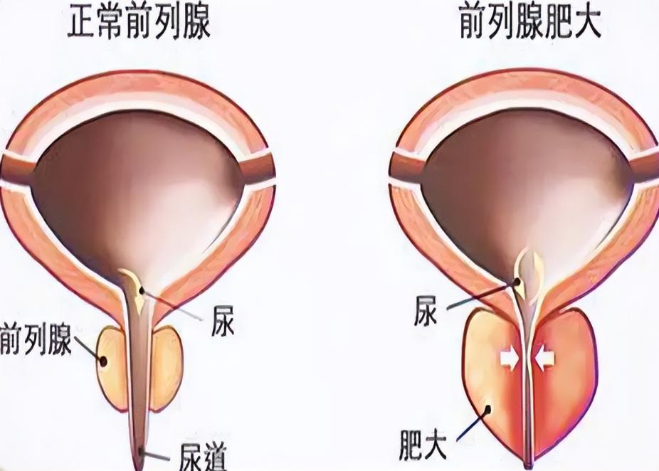 老中医40年经验方，专调前列腺，通补结合，50岁以上必看！很多50岁以上的男性