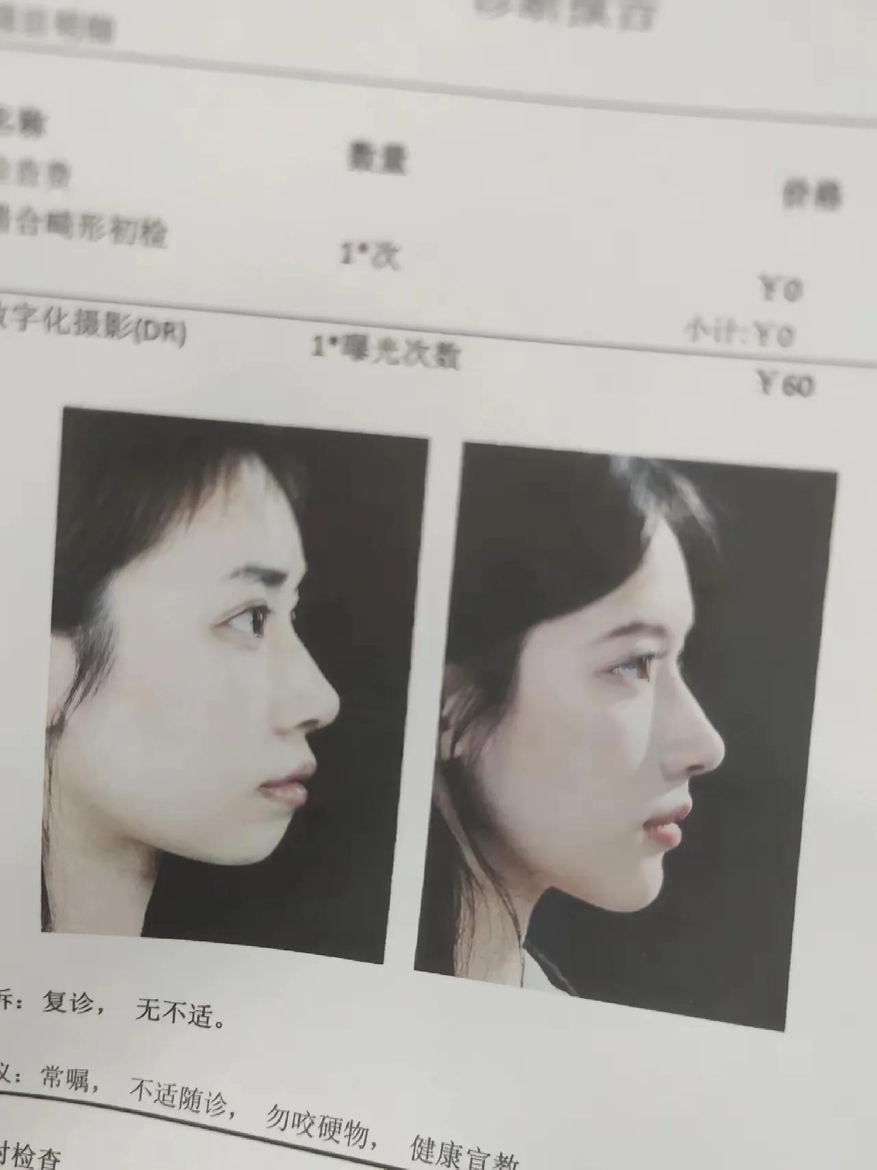 这脸部变化那么大，难道不是削骨结果？你信只是动了牙齿才会这样吗？