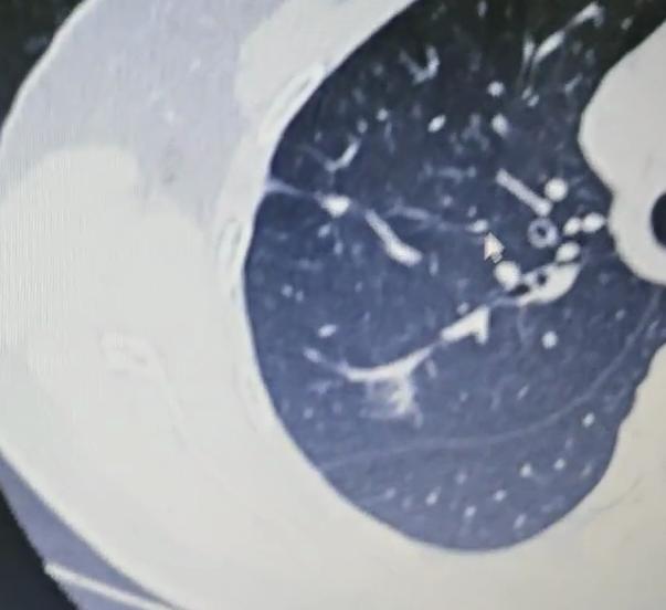 肺结节随访别漏这个细节，小心进展被忽略！不少人查出肺小结节，特别是磨玻璃结节后，