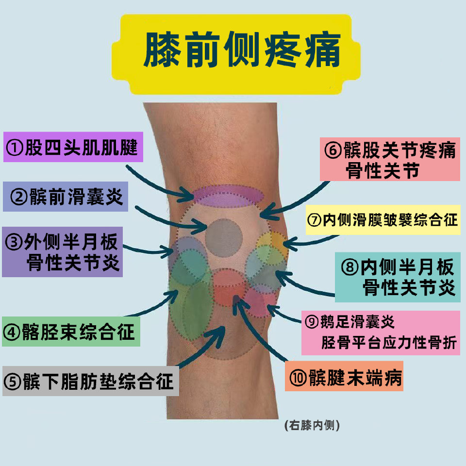 膝关节损伤前两天发了科普视频，膝盖前侧痛盘点，有朋友想看图文总结版——你的膝关