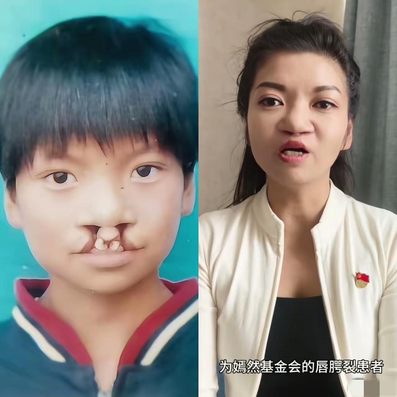 大家发现了没有为什么那7000例免费治疗唇腭裂患者很少有人站出来帮李亚鹏发声，