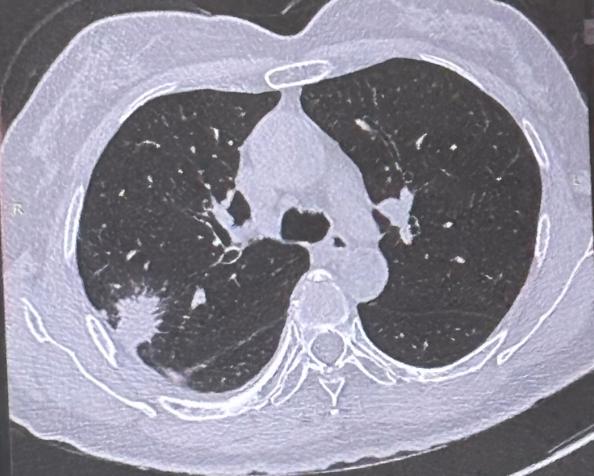 肺腺癌和肺鳞癌，到底哪个更严重？我会从起源位置、症状表现、高危人群、转移特点、治