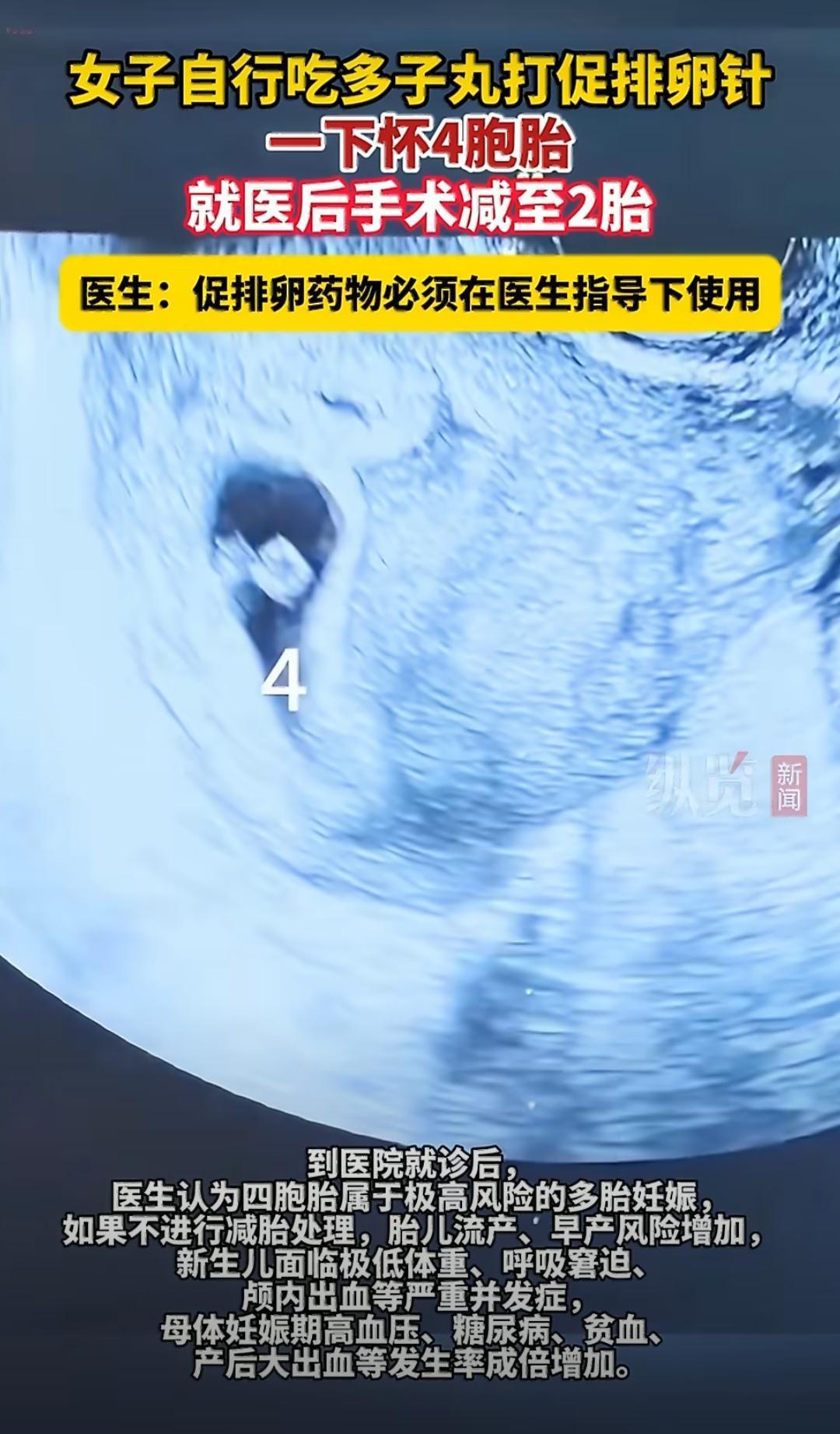 江苏淮安有个李女士，因为备孕老怀不上，就自己在药店买了“多子丸”这种促排卵的药，