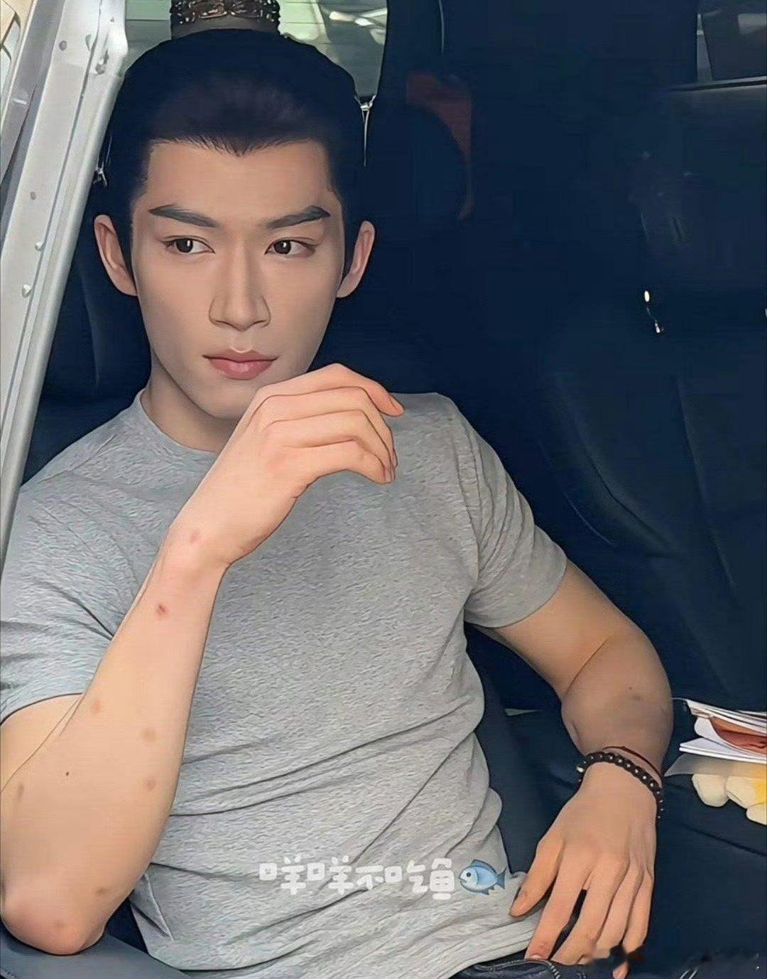 王星越这胳膊上密密麻麻的圆点是啥？蚊子咬的嘛？？？？​​​​