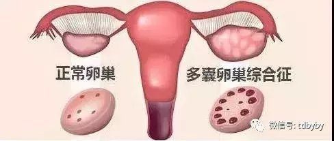 关于多囊卵巢综合征, 这十点你要懂!