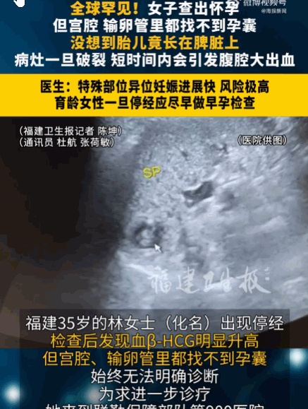 全球罕见！福建，一35岁女子停经后查出血β-HCG异常升高，陷入无尽恐慌。医生反