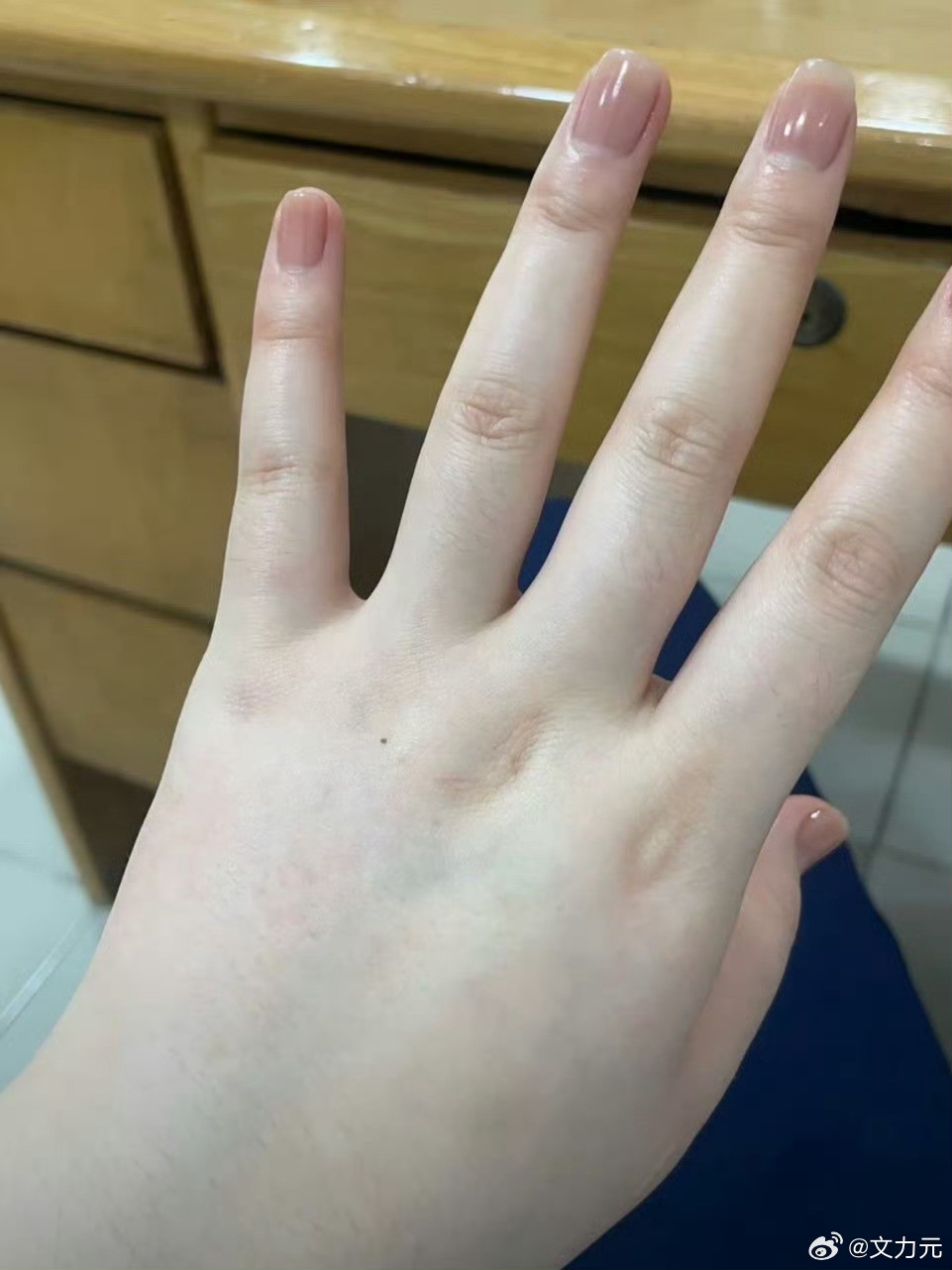 瘦了二十斤后手的变化，不是吧，原来这样的变化只需要瘦20斤吗？我以为得瘦四五十斤
