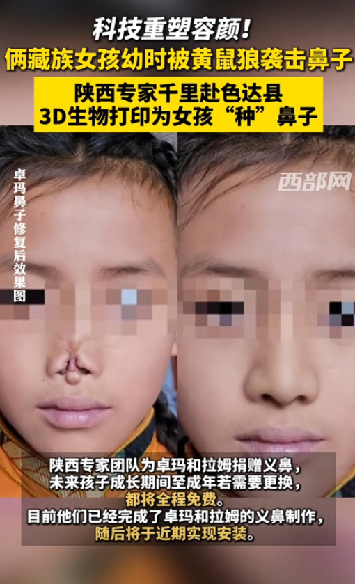 “这才是真专家！”四川甘孜，两名藏族女孩小时候睡觉时，意外被黄鼠狼咬下了鼻子，造