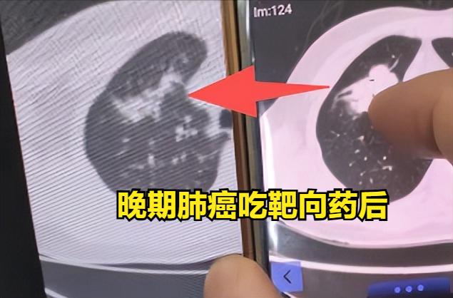 早期肺癌拖成晚期！只因为一个“怕”字......国庆节后的第一个门诊，看了90多
