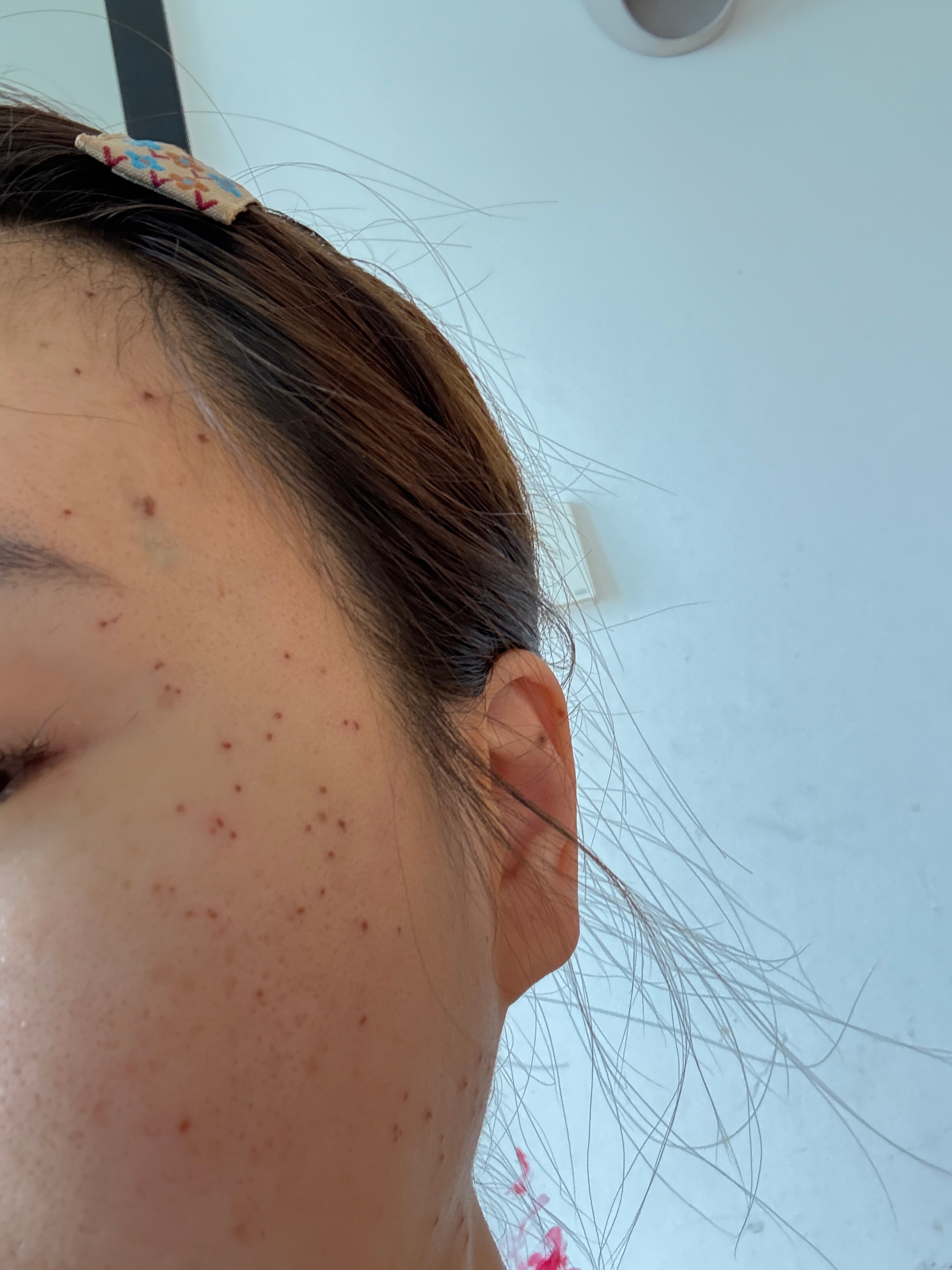 还有一件事是我去点扁平疣了医生说一个100块，一脸2000块我说我按个吧？医生说