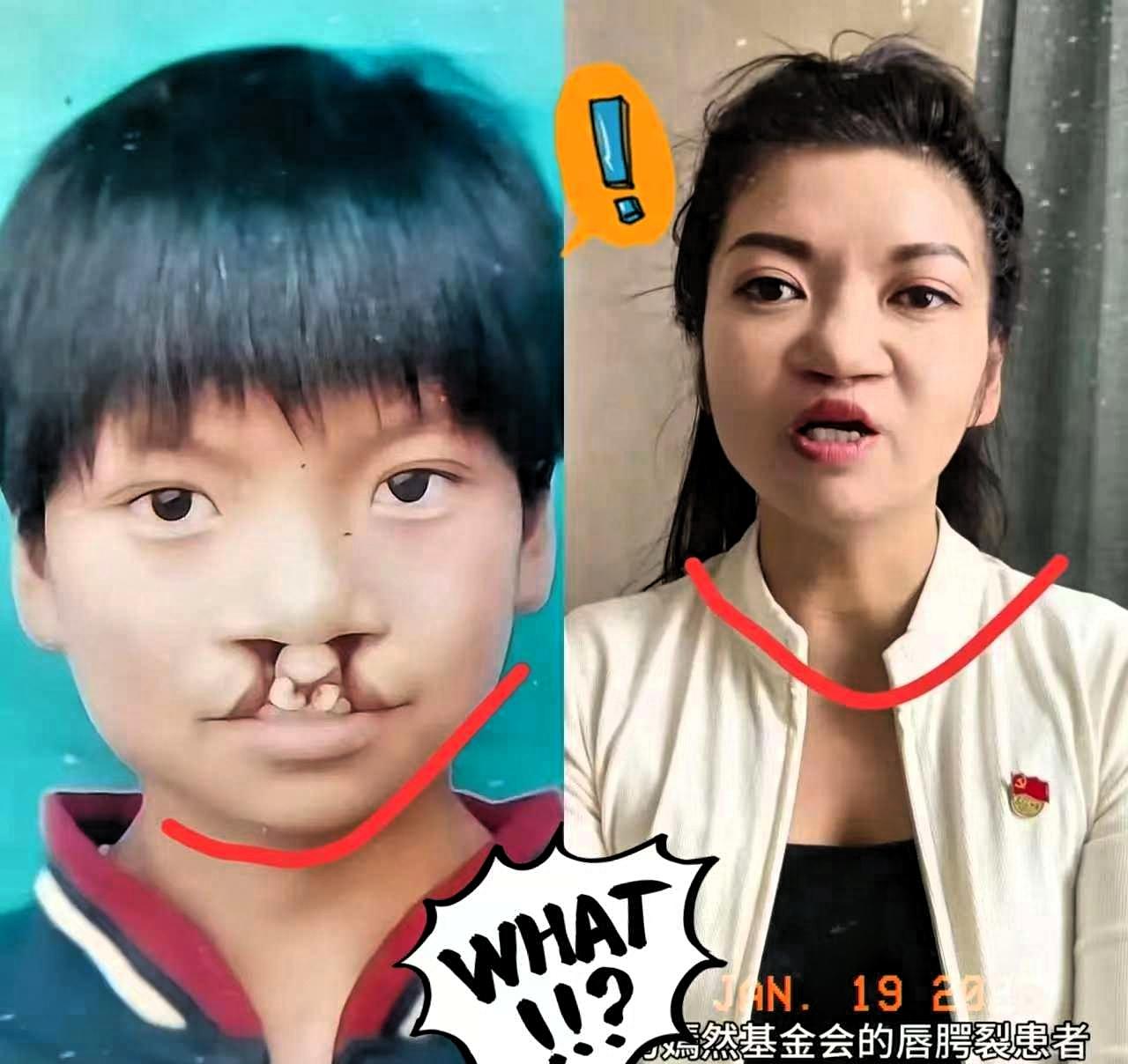 大家发现了没有为什么那7000例免费治疗唇腭裂患者很少有人站出来帮李亚鹏发声，