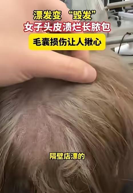 “上海一女子漂发后头皮溃烂化脓，医生诊断化学灼伤，恐难再生发”上海一女子去理