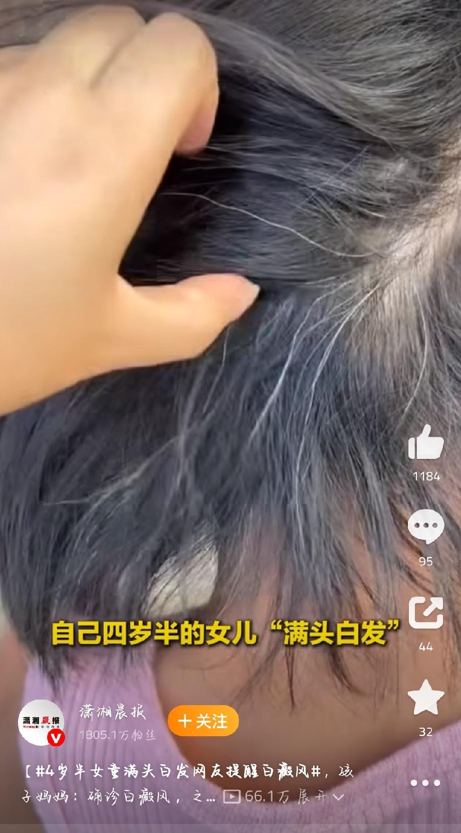 最近看到个事儿，有宝妈发了4岁半女童满头白发的帖子，网友提醒可能是白癜风。后来宝