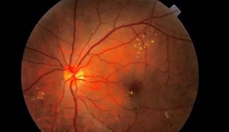 中国饭桌热气腾腾，一杯白酒下肚，糖尿病患者瞬间尿崩口渴，夜间低血糖风险飙升2.3