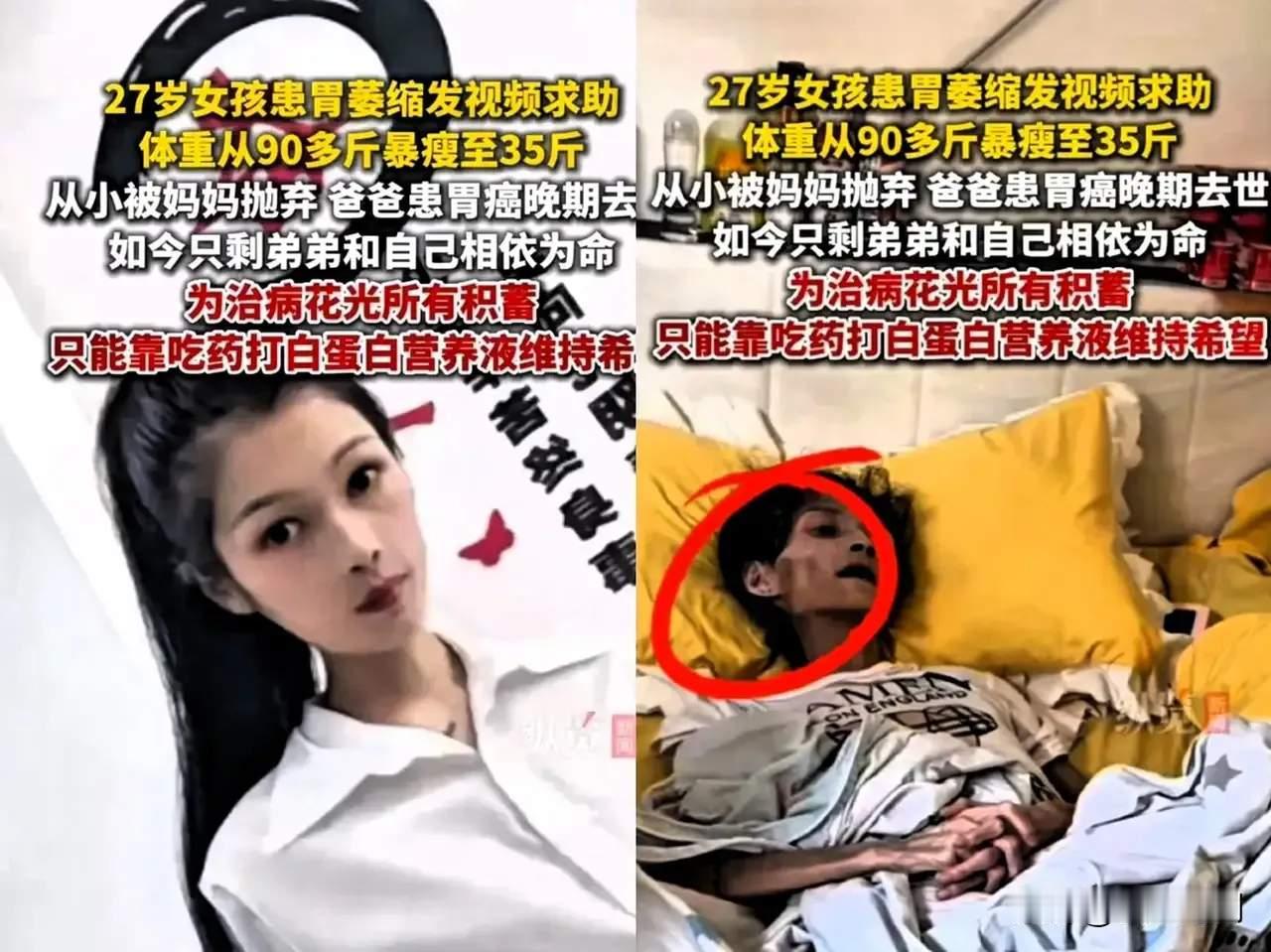 警惕！27岁女孩胃萎缩暴瘦至35斤离世，这病太凶险！太痛心了！一位年仅27岁