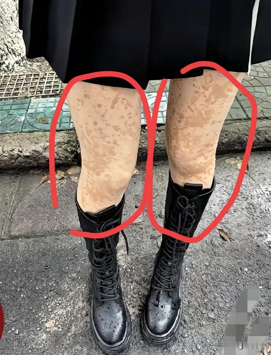 今天在公交车站偶遇个女孩，腿上的斑斑点点看得我有点心惊，第一反应是“这啥皮肤