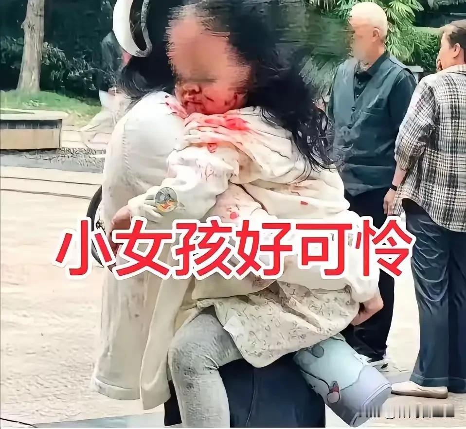 四川眉州被咬的女孩，这辈子都会和疤痕相伴了。看她脸上的伤口，耳朵旁直接缺了一块