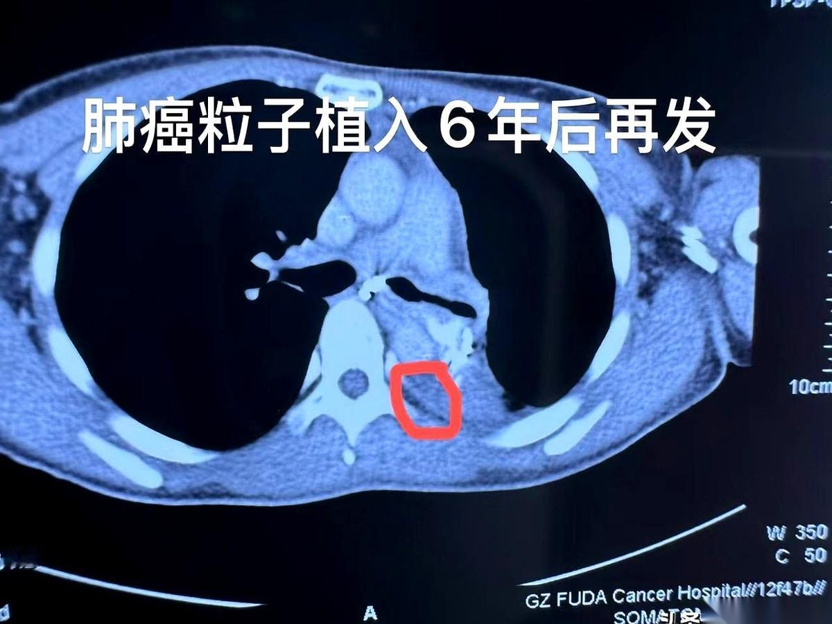 翻开一个晚期肺癌患者的就诊记录，那条时间线，看得人心里一抽。6年前，第一次手术