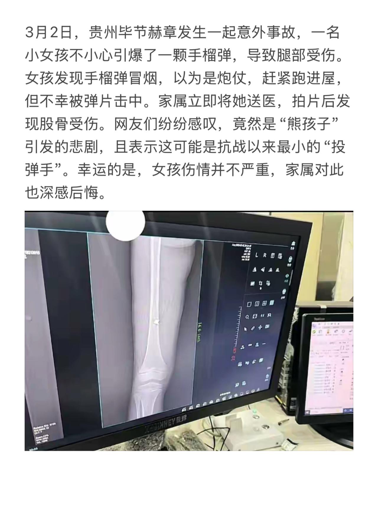 贵州6岁女童捡到“玩具”竟炸穿铁门！弹片入骨，惊魂一幕，背后真相令人胆寒！轰！