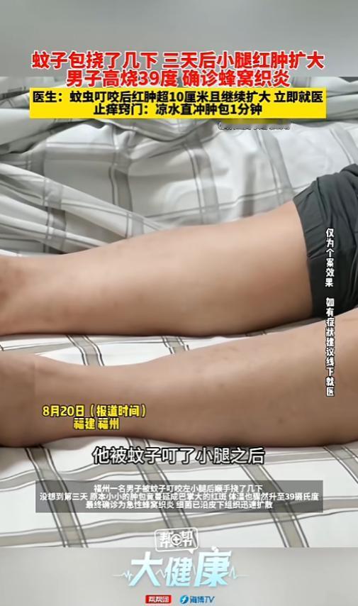 “长知识了！”8月20日报道，福建福州，一男子小腿被蚊子咬了，他觉得痒顺手挠了几