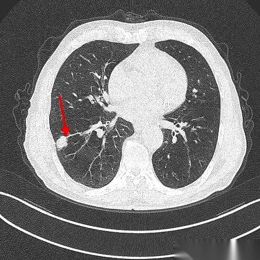 肺鳞癌，手术切完9年了，人活得好好的。最绝的是，这大爷手术后烟都没戒。真的，