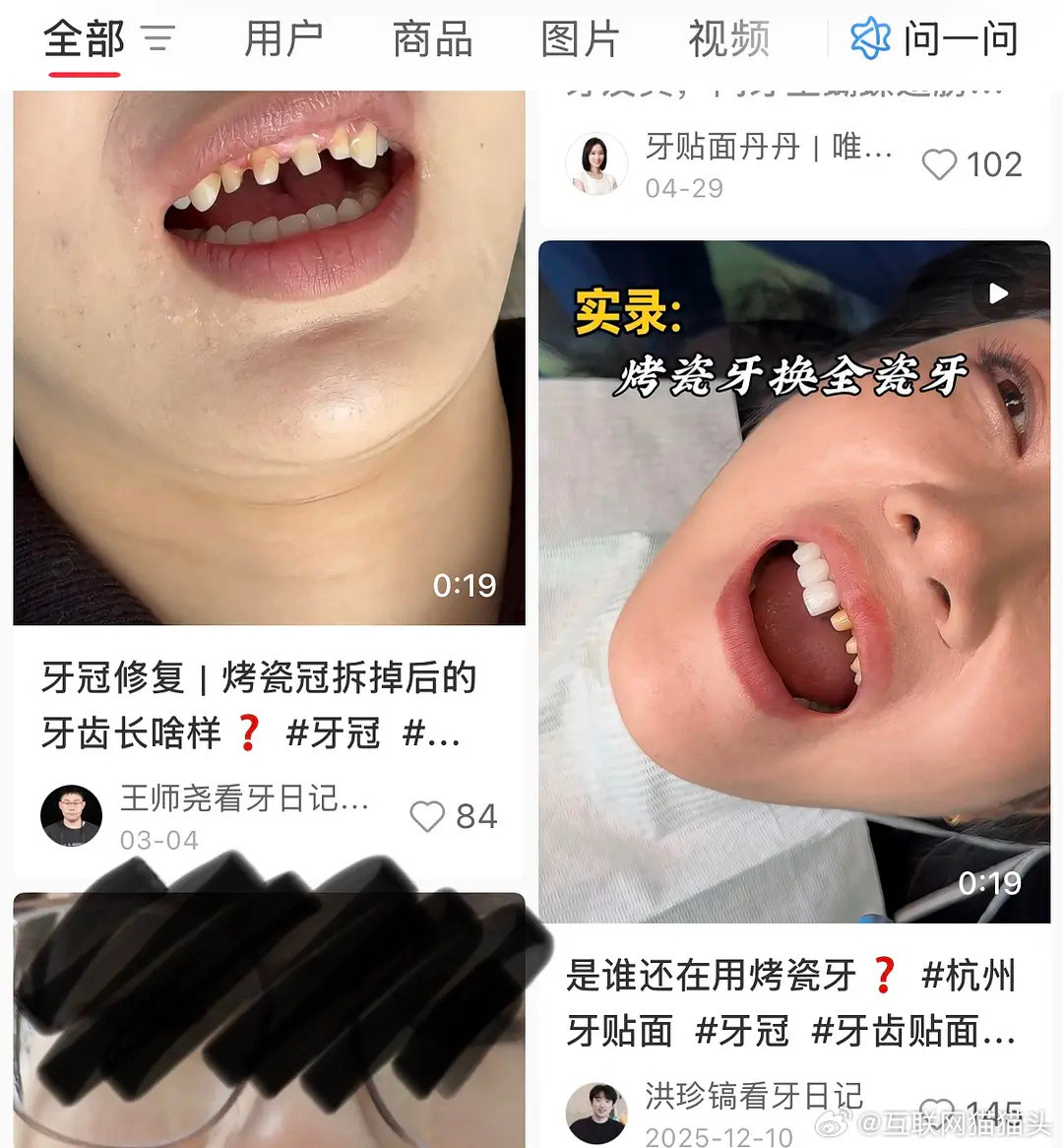 才知道烤瓷牙是要把自己的牙磨小再套牙冠好佩服做烤瓷牙的这些明星🤡