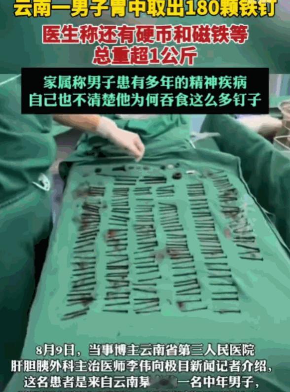 谁能想到人胃里能装下180多颗钉子？云南这病例刷新医生认知。男子腹部剧痛急诊