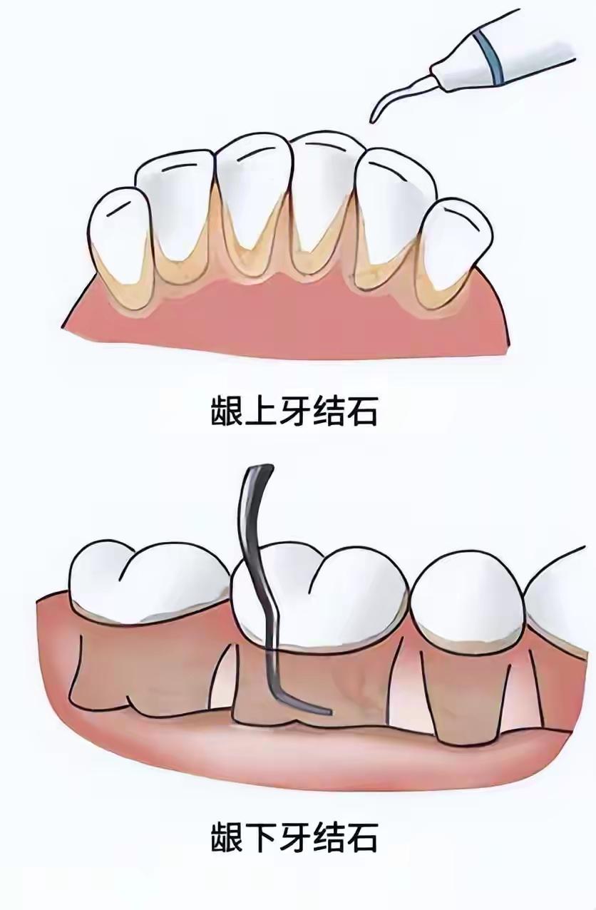 我都64岁了，可是别人都羡慕我的牙齿一颗没掉。但是我这几年也很郁闷，看着一口