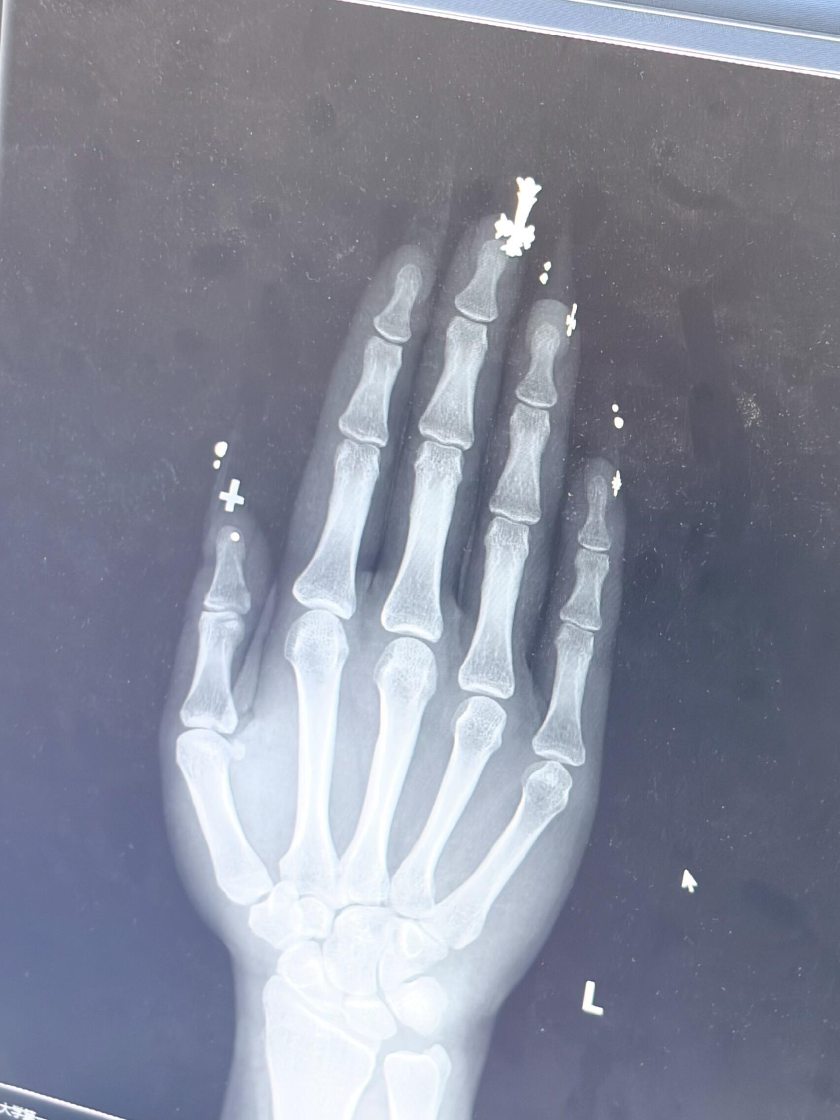 做CT不让做美甲的原因