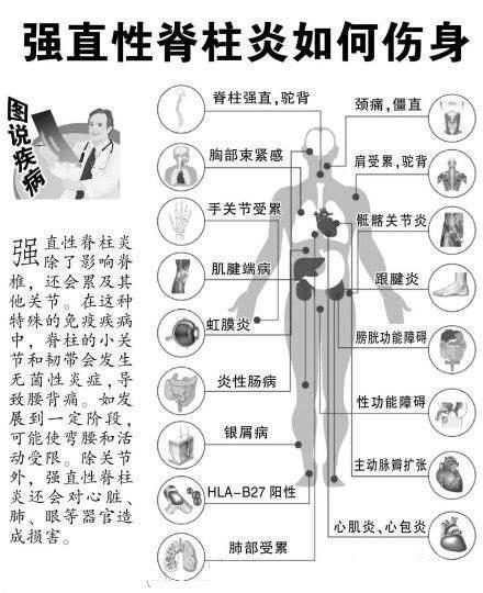 强直性脊柱炎属于重大疾病险 大病保险包括强直性脊柱炎么