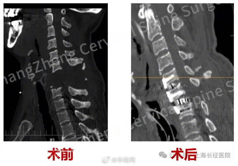 【全球罕见！#身首离断患者被救回#主刀医生：术毕两月整，已脱离呼吸机半月】#医