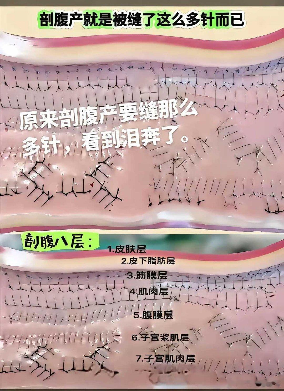 情感原来剖腹产要缝这么多针，看着都泪奔了[哭哭][哭哭][哭哭]​​​
