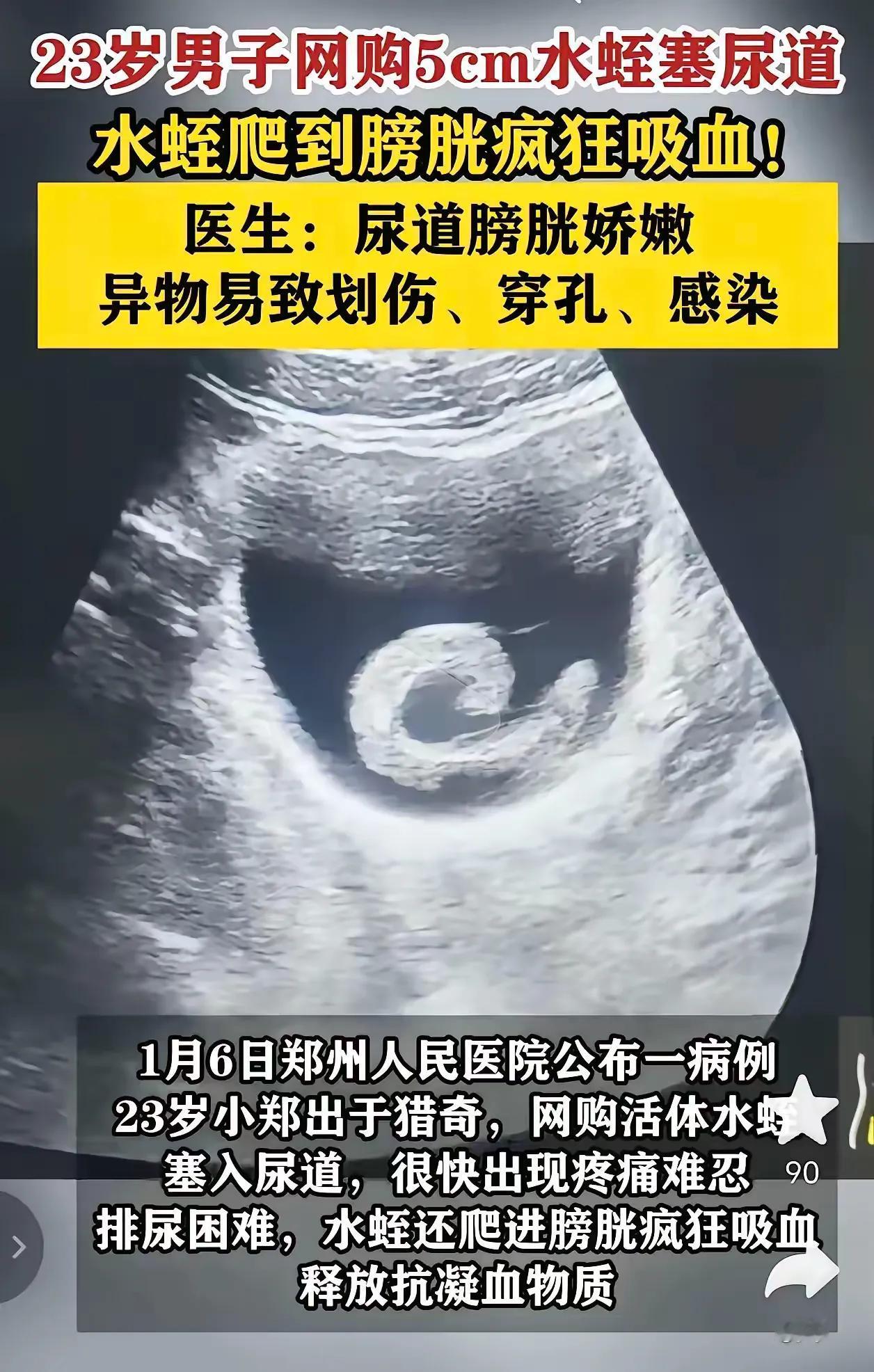 无知真可怕！河南郑州，一23岁男子出于好奇，网购5cm的水蛭塞入尿道，很快腹痛难