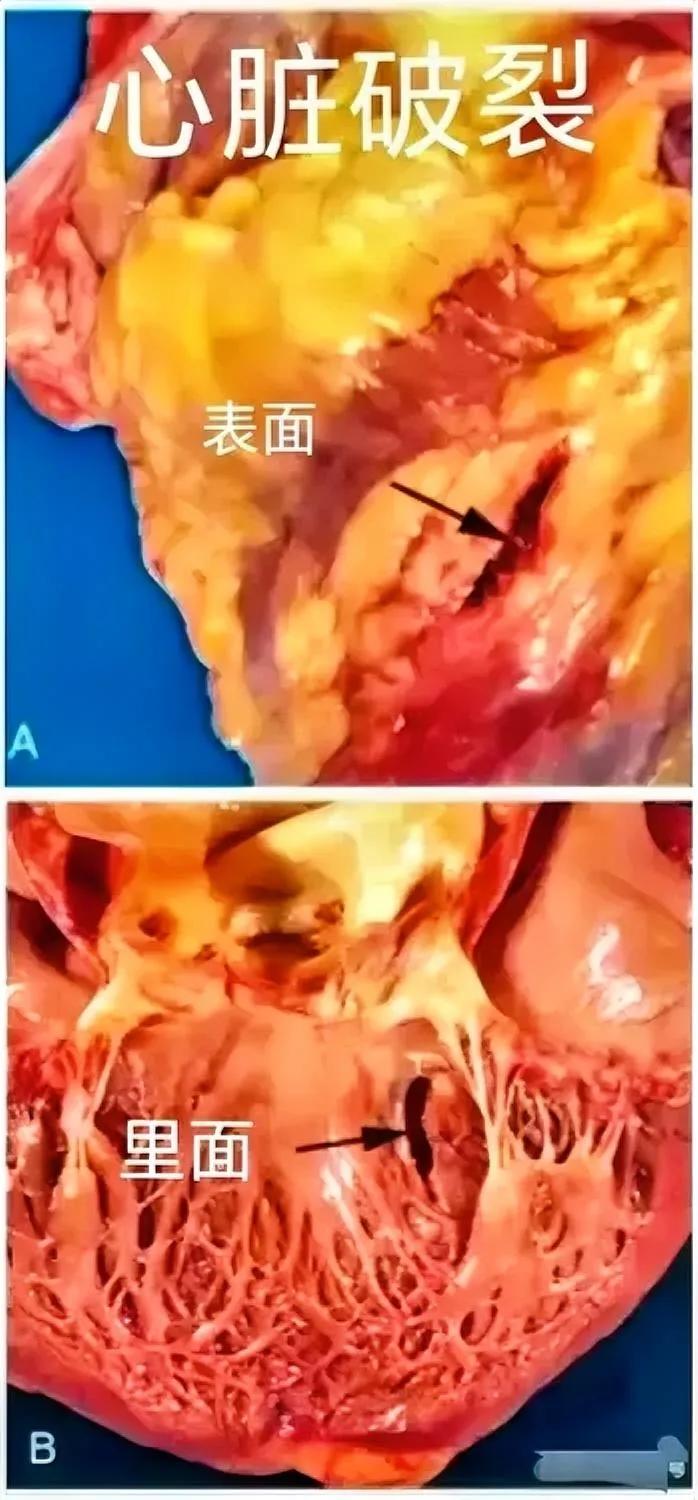 心脏破裂！😡一旦发作，九死一生！有的人，得了心肌梗死，不过抢救及时，