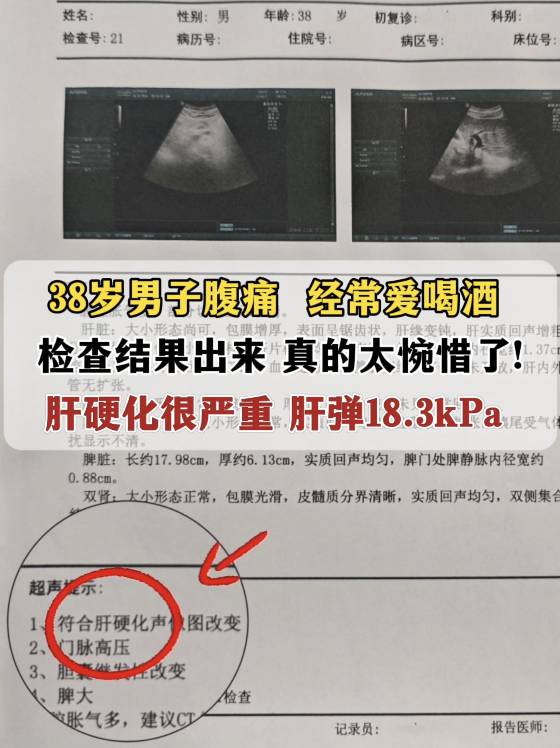 有乙肝的可别再喝了！上午有个38岁的山东小伙，就是因为管不住酒杯，转氨...