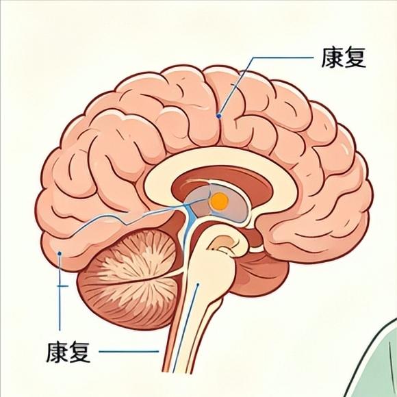 脑出血后还能活多久？医生说实话：主要看这三点第一点：后遗症的严重程度和控制情