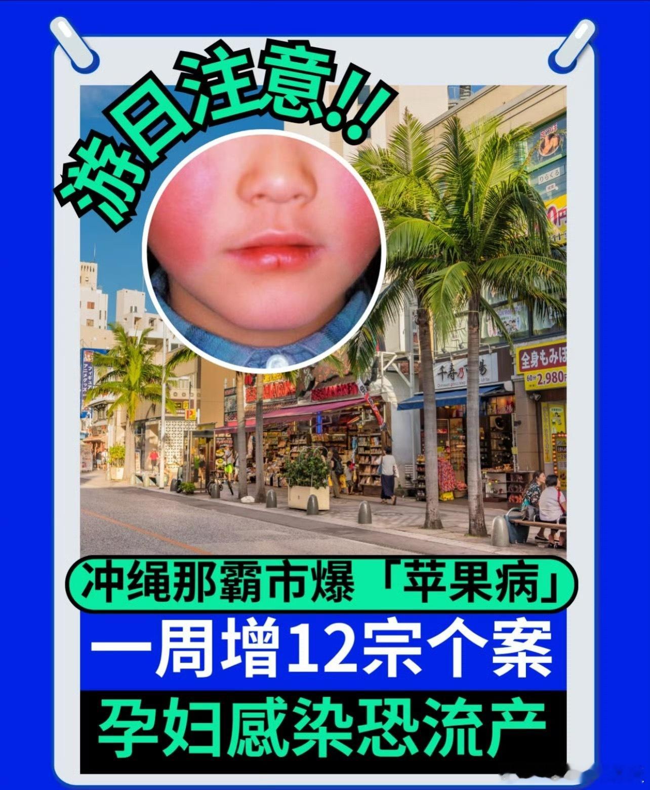 日本苹果病日本近期出现可传染性“苹果病”，初期症状类似感冒容易被忽视，但可通