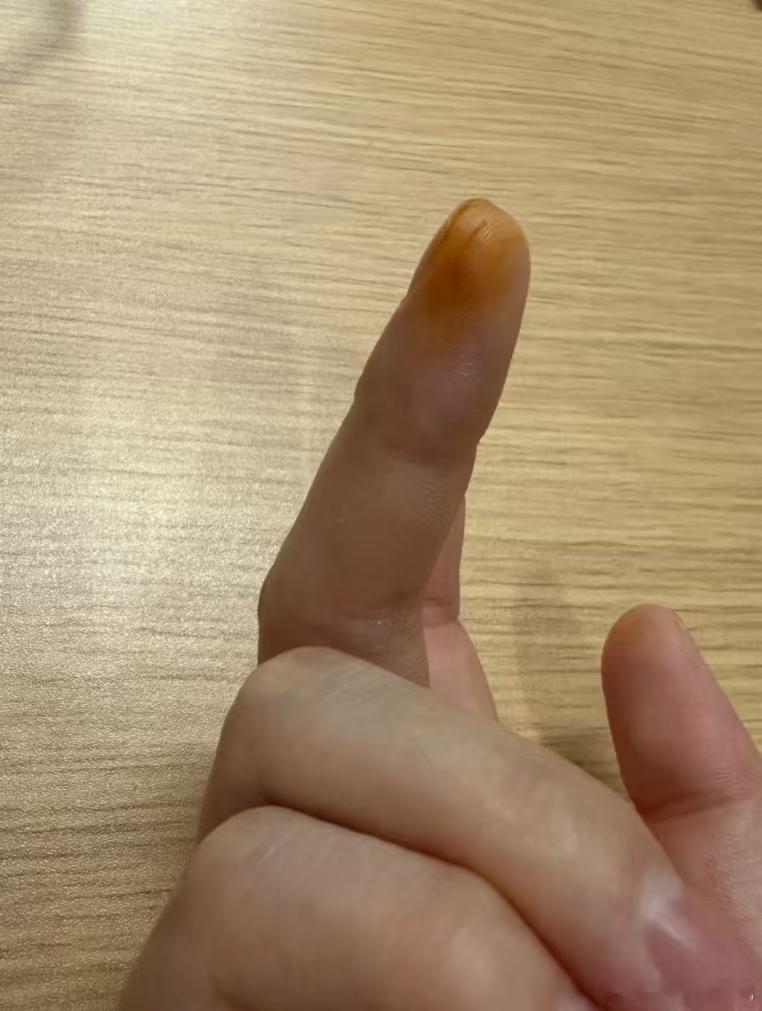 你以为没事其实很危险的行为被钢板划伤，上面有锈，然后用水冲了一下，碘伏消了毒，次