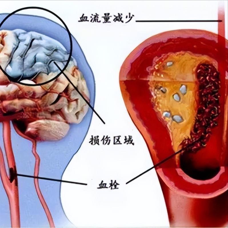 梗后半年又复发，多半是这4点没做到位！脑梗出院≠万事大吉！总能听到患者家属抱怨