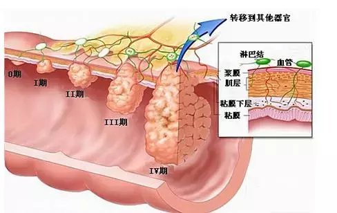 吕梁肛泰专家: 威胁生命的直肠癌问题, 你了解多少?