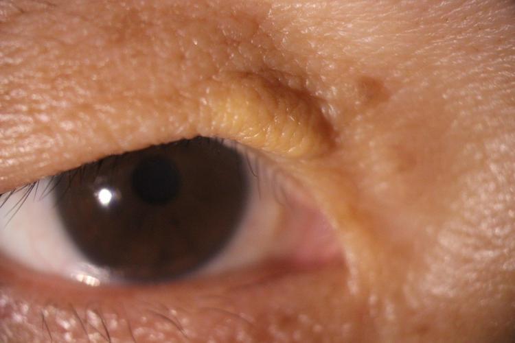 医生告诫：眼睛若有这2征兆，或许心梗已经找到你了，尽快就医！眼睛出了问题，第