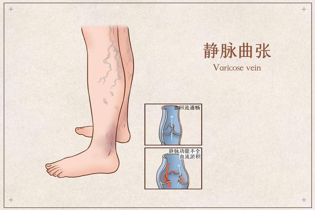 6类人群40岁以后, 做好静脉曲张预防, 出现症状及时就医