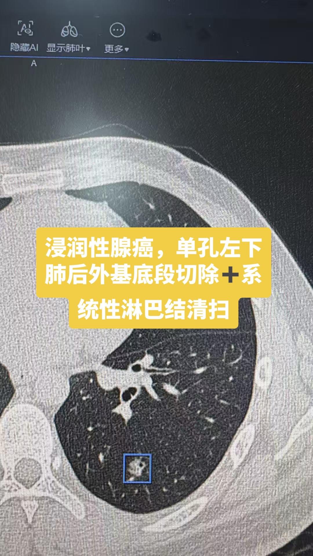 病例展示。浸润性腺癌，单孔左下肺后外基底段切除➕系统性淋巴结清扫