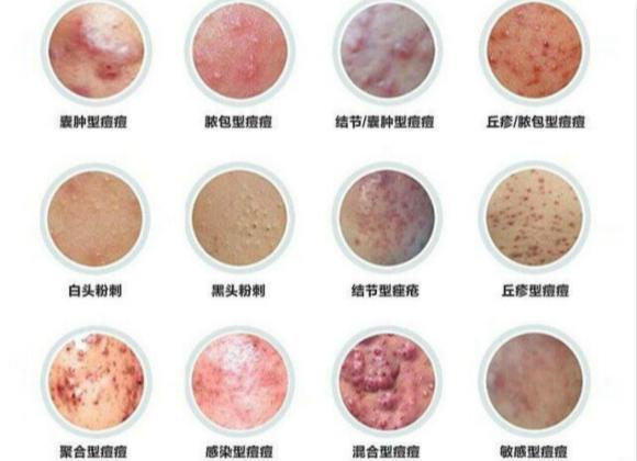 痘痘类型及治疗方法