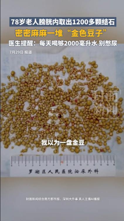 “太吓人了！”深圳，一位78岁的老伯体内竟然取出来了1200余颗结石，一粒粒金黄