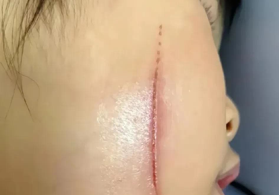 山东，一名女子的女儿在学校和同学打闹时，被同学用笔划到了脸，瞬间，她的脸上出现了