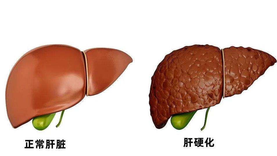 别等肝硬化才慌！喝酒时若有这5种反应，肝可能早受损了。很多人误当酒量差硬扛，