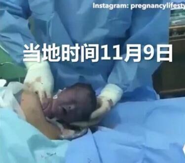 顽强的小生命! 婴儿靠自己力气从妈妈肚子里挣脱出世! 好感人 赞