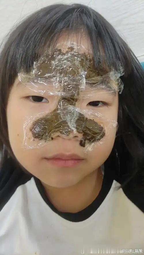 三味妙药磨成粉直接敷在穴位上，孩子抽动症，多动症和情绪不稳都能用儿童抽动症引发